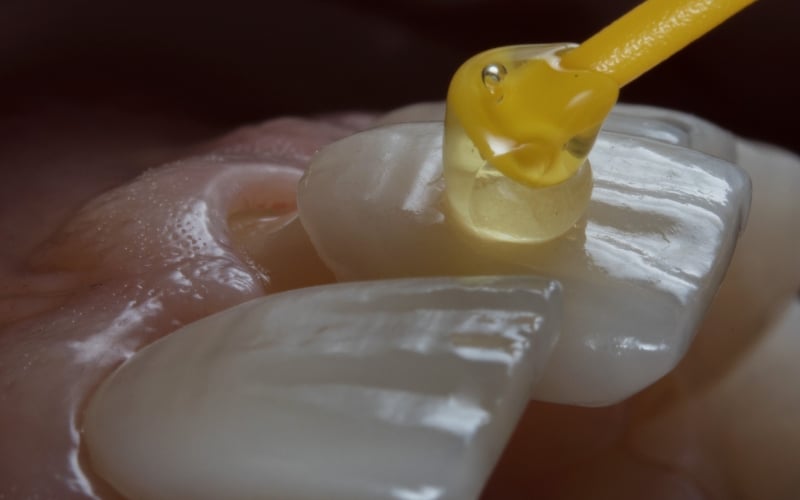 dental veneers aesthetic and functional benefits